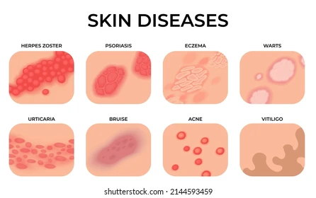 General Skin Disorders